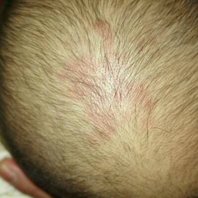 宝宝四个月,头皮上一块一块的发红,是什麼原因?