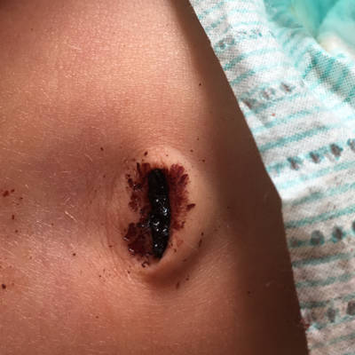 我家宝宝当时那样我就用肚脐带给包着,没有用什麼,后面就好