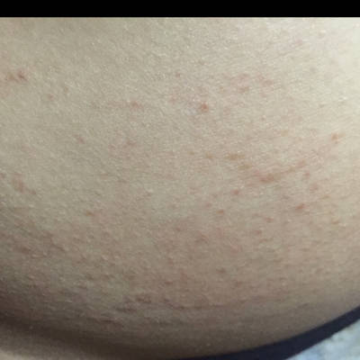 孕21周4天的肚皮两侧起这种小红点还特别痒是怎麼回事呢?
