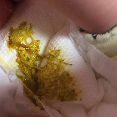 宝宝一个多月,常吐奶,嗝每次都拍,但经常拍不出.