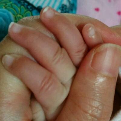 宝宝缺钙指甲白斑图片图片