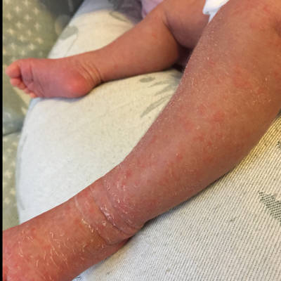 婴儿病毒性湿疹图片