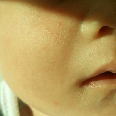 宝宝脸上的红点点是怎么什么,他一直是吃母乳喂养需不需要搽药这些