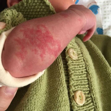 新生儿荨麻疹图片