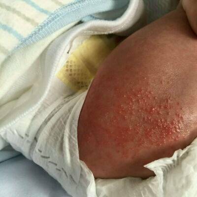 女宝宝尿布疹初期图片图片