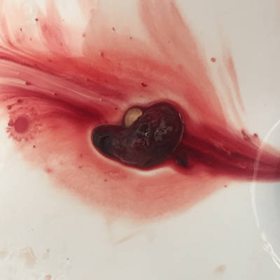 宫腔血块图片