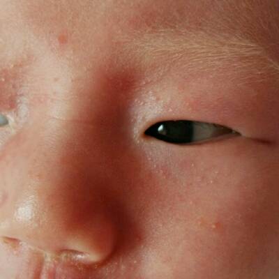 宝宝脸上长小米粒图片图片
