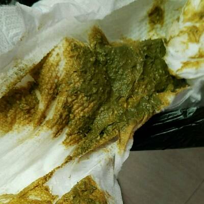 人工餵养的宝宝大便这样正常嘛,很臭