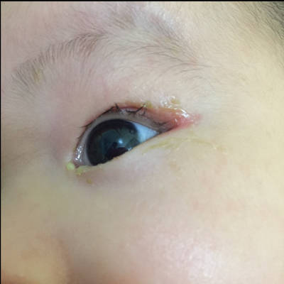 宝宝2个月了,眼睛老是有很多分泌物,眼屎也比另一只眼多,最近眼角和上