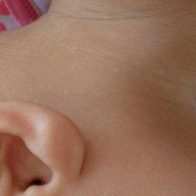 宝宝脖子上有白色粒疹图片