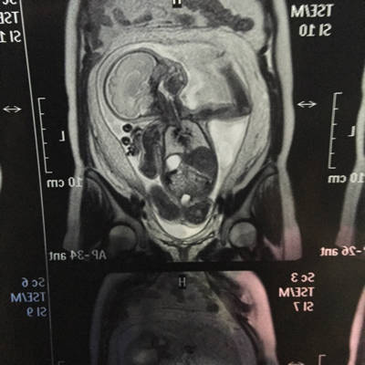 胎儿核磁共振结果图片图片