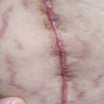 剖腹产伤口化脓图片图片