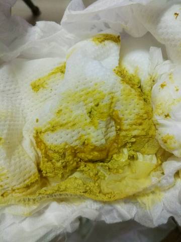 图片比较恶心不好意思,每次他拉完屎我都要检查研究一下性状,酸臭臭.