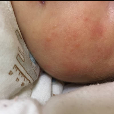 宝宝甲醛中毒疹子图片图片