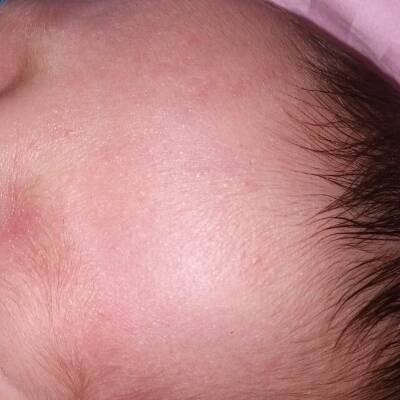 婴儿脸上米粒小疙瘩图图片