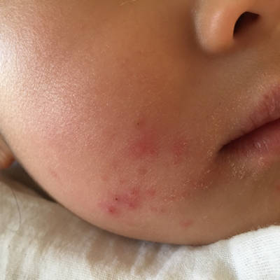 宝宝三岁十个月了,最近嘴角出了好多痘痘(如图),怎麼回事?