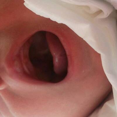 儿童嘴巴上颚白色褶皱图片