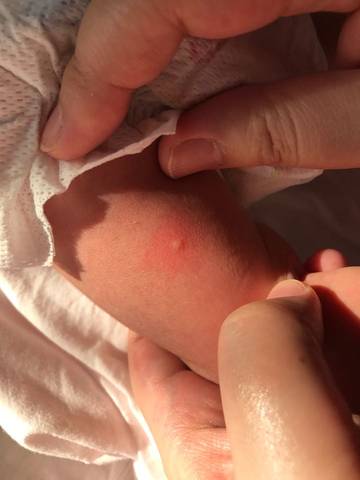 新生儿脓疱疹 婴儿图片