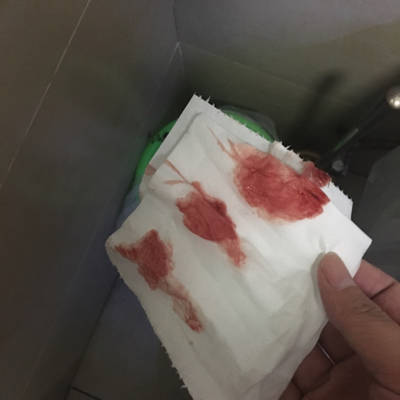 孕12周2天,刚刚有些流血,12周做nt一切正常,怎麼办,会不会流产