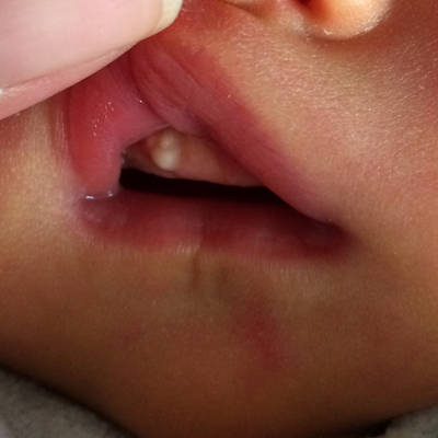 宝宝生下来牙根上长个这个白色的东西现在宝宝才四天,问医院医生说