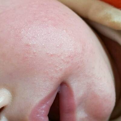 宝宝脸上这种湿疹好久还不好,宝妈们有什麼好办法木有