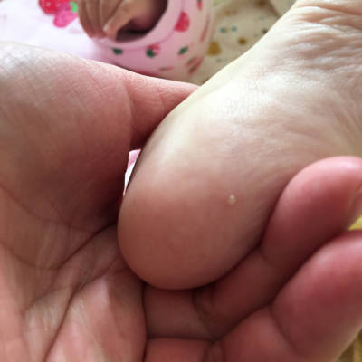 请各位宝妈和专家帮我看看,宝宝脚底板下长了一颗白色的点,以前一小颗