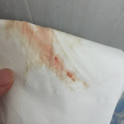 末次月经1月5日,前天去照b超!排除宫外!这两天出点血,是怎麼回事?