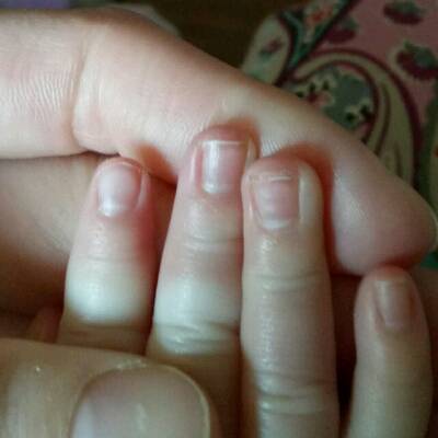 宝宝快五个月了,指甲上有竖纹,有的还有点不平,请问这是缺什麼吗?