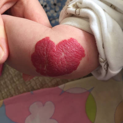 婴儿腿上红色血管瘤图片