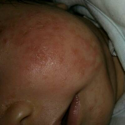 新生儿面部湿疹图片图片