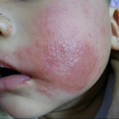 孩子脸上长疱疹的图片图片