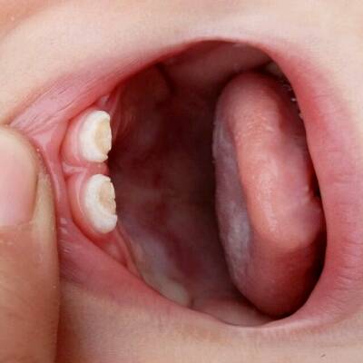 婴儿牙齿骨面图图片