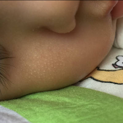 六个月宝宝脸上起的小白点怎麼回事