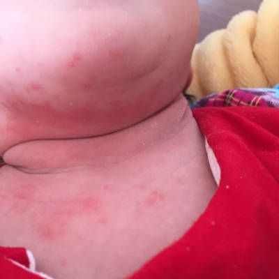 宝妈们看看我家宝宝起的红点是不是湿疹,有什么好的办法吗?