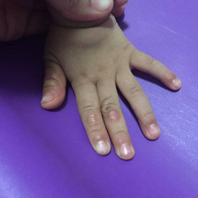 宝宝两岁半 请问怎麼解决吃手的习惯 还有手指起茧子不明原因