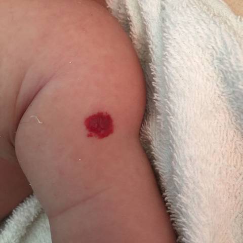 婴儿轻度血管瘤图片图片