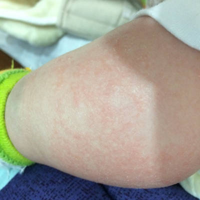 宝宝四个半月,四肢跟躯干都起了很多红疹子,一遇热就红,过一段时间后