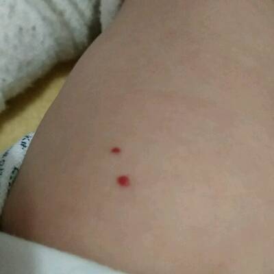 婴儿腿上有出血点图片图片