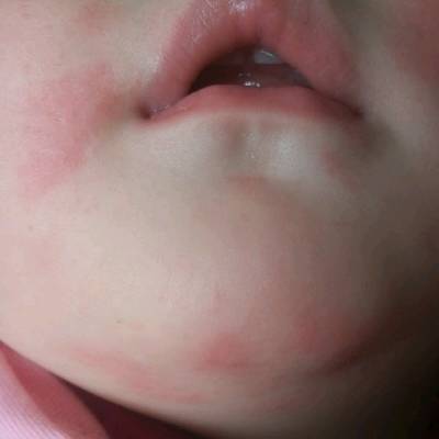 婴儿嘴角内侧疙瘩图片图片