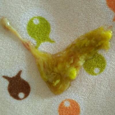 拉肚子有粘液带血丝