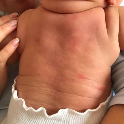 婴儿背部红疹图片
