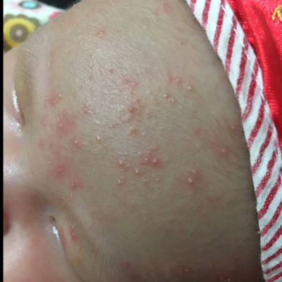 是湿疹还是火气大起的疹子?