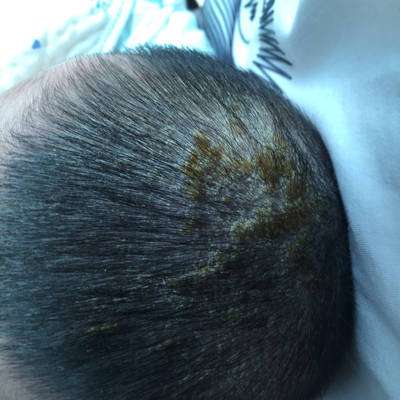 3个月宝宝头上长了痘痘一样的颗粒,有白脓,第二天