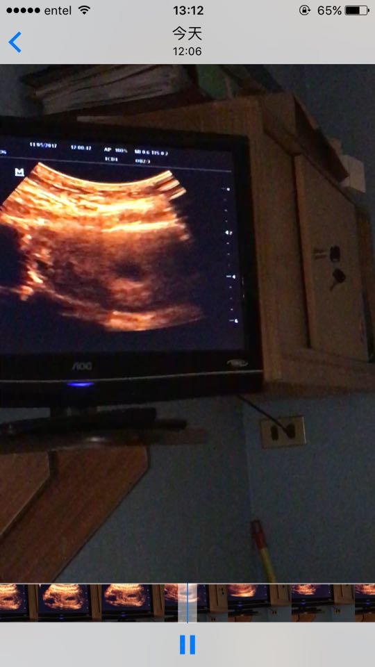 新出炉视频帮忙看男女 7周有胎芽胎心