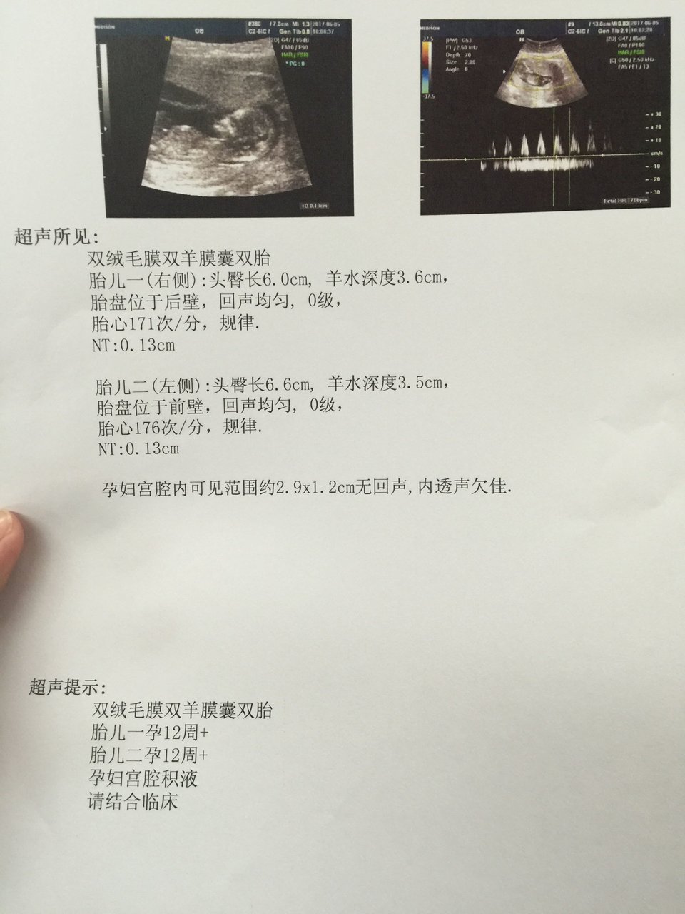 11周见红，12周nt顺利通过！！双宝都很好！传正能量！！