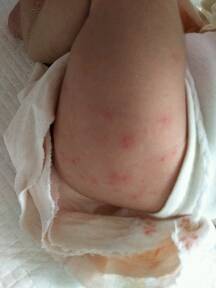 宝宝热毒疹子图片图片