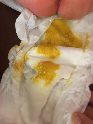 各位宝妈,56天宝宝一天拉大便十几次,便便里有鼻涕状的黏液,吃了