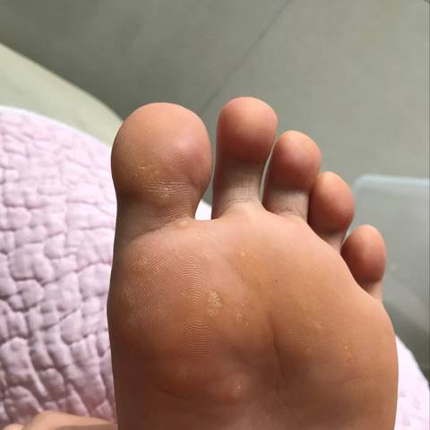 有没有脚上长疣的?怎麼治?