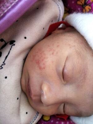 宝宝脸上起这种小痘痘,两边脸颊都有呢,其它地方没有,怎麼回事?