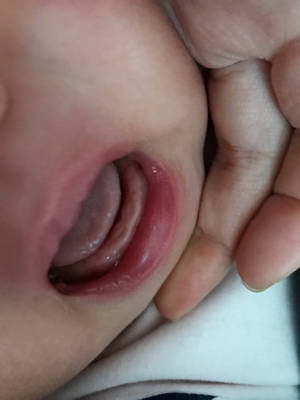 婴儿牙龈白色图片